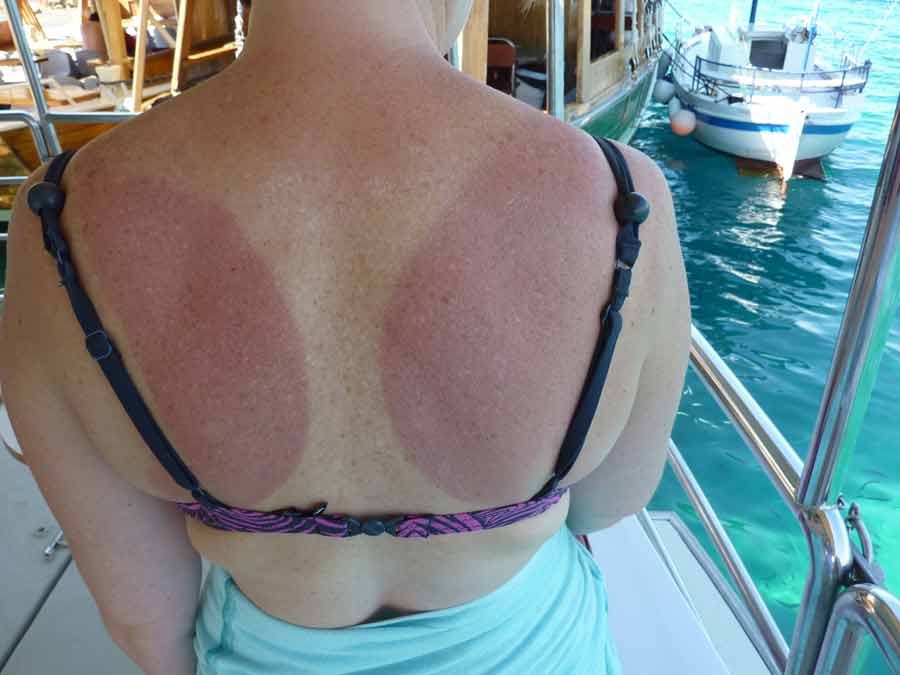 Dos brûlé par le soleil après une sortie en mer en Croatie, preuve que le soleil tape fort et qu’il faut bien choisir quand voyager en Croatie